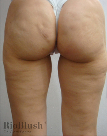 Cellulite marks before