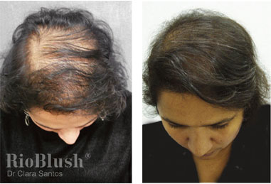 Stretch marks after