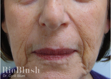Stretch marks before