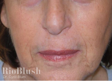 Stretch marks after