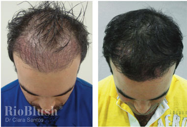 Stretch marks before