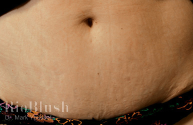 Stretch marks after