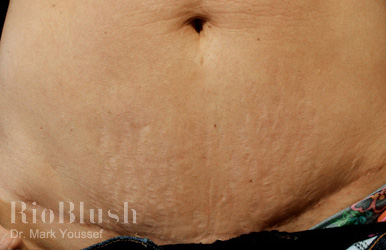 Stretch marks before